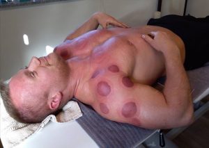 Behandling med cupping af bodybuildere og atleter